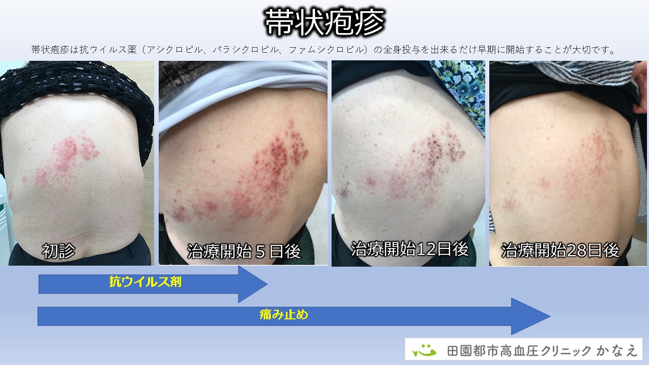 帯状疱疹のかさぶたは治るまでどれくらいかかりますか？